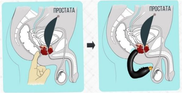 Masszírozó a prosztatagyulladásból